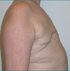 Recontructive Procedures Breast DIEP Bilateral Delayed Before