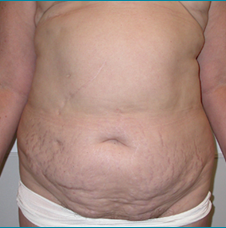 Recontructive Procedures Breast DIEP Bilateral Delayed Before