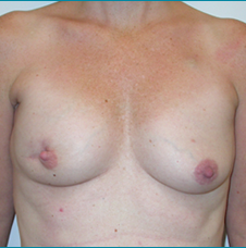 Recontructive Procedures Breast DIEP Bilateral Immediate Before