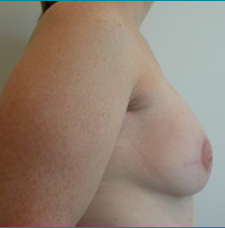 Recontructive Procedures Breast DIEP Bilateral Immediate After