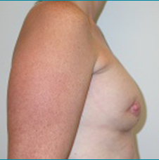 Recontructive Procedures Breast DIEP Bilateral Immediate Before