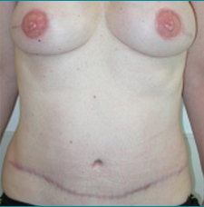 Recontructive Procedures Breast DIEP Bilateral Immediate After
