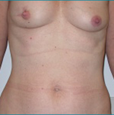 Recontructive Procedures Breast DIEP Bilateral Immediate Before