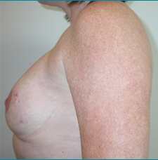 Recontructive Procedures Breast DIEP Bilateral Immediate After