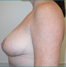 Recontructive Procedures Breast DIEP Bilateral Immediate Before