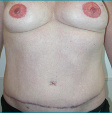 Recontructive Procedures Breast DIEP Bilateral Immediate After