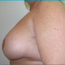 Recontructive Procedures Breast DIEP Bilateral Immediate After
