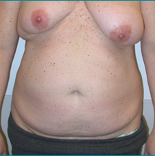 Recontructive Procedures Breast DIEP Bilateral Immediate Before