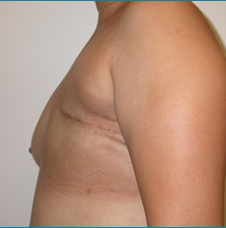 Recontructive Procedures Breast DIEP Unilateral Delayed Before