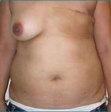 Recontructive Procedures Breast DIEP Unilateral Delayed Before