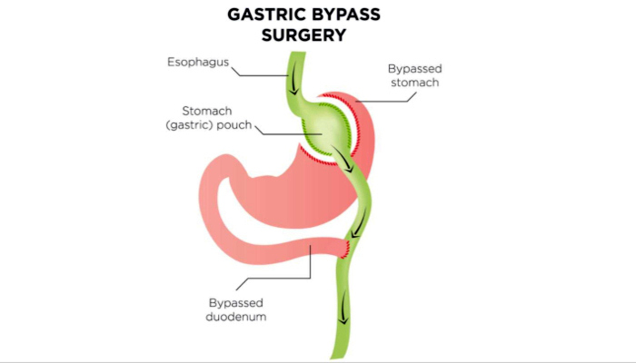 This is a medical illustration of the gastric bypass procedure