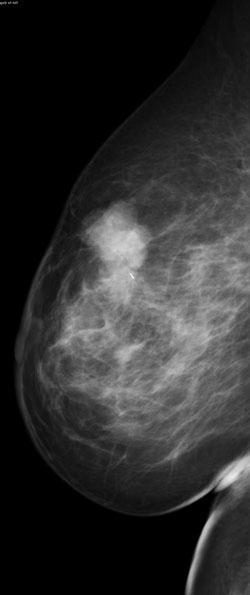 Palpable mass in the upper breast 