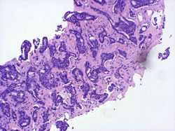 Stereotactic Core Biopsy Histopathology