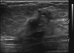 Ultrasound demonstrates a dominant spiculated and irregular hypoechoic mass 