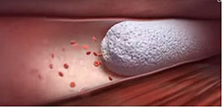 Chemical Foam Ablation