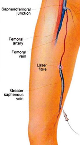 Endovenous Thermal Ablation