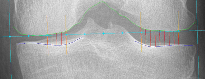 Radiographic JSW at fixed locations