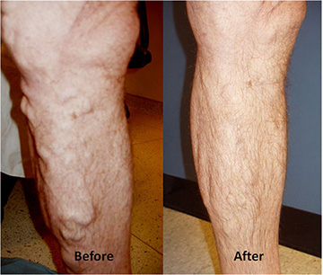 Endovenous thermal ablation of saphenous vein for varicose vein treatment