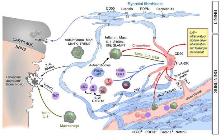 (Figure) The perivascular (sublining) fibroblasts becoming activated by leukocyte-derived cytokines to become the major source of IL-6 and many chemokines and driving degradation of the cartilage, and bone erosion via osteoclast activation.