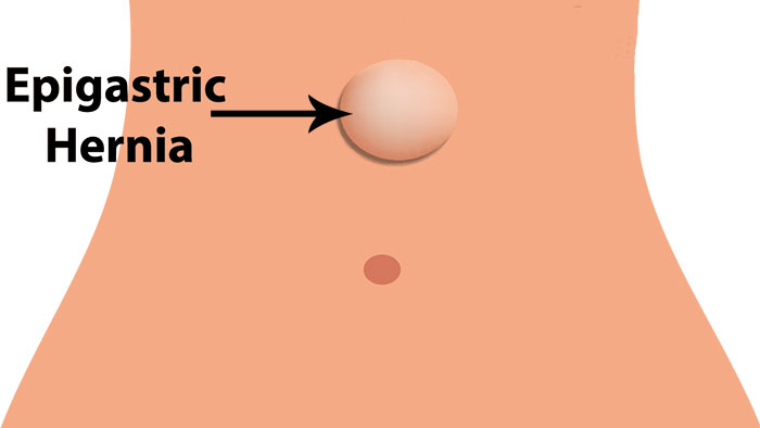 illustration of epigastric hernia